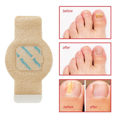 Breathable hypoallergenic material of Nichalous patches close-up