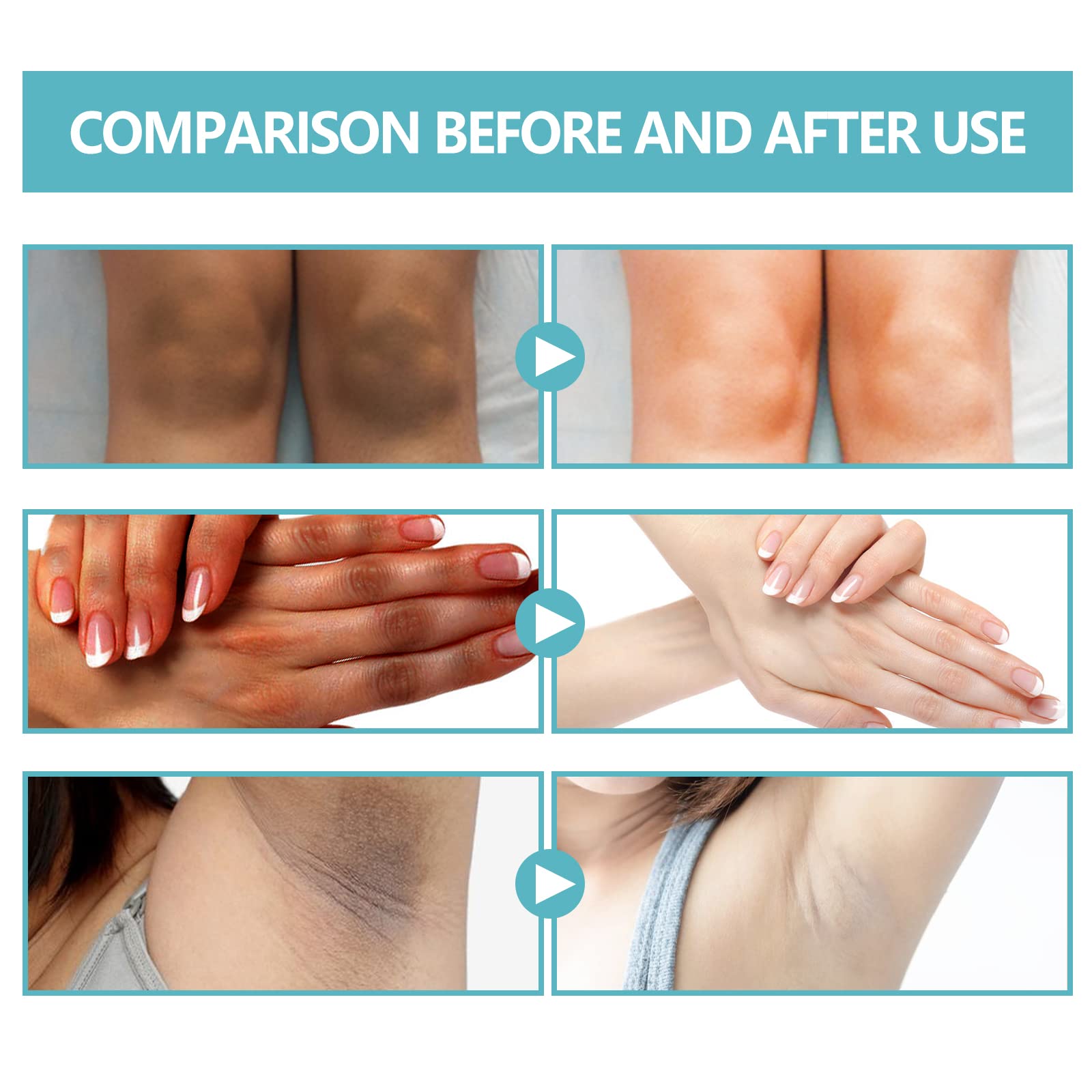 Nigrifix therapy cream used on intimate areas for targeted care.