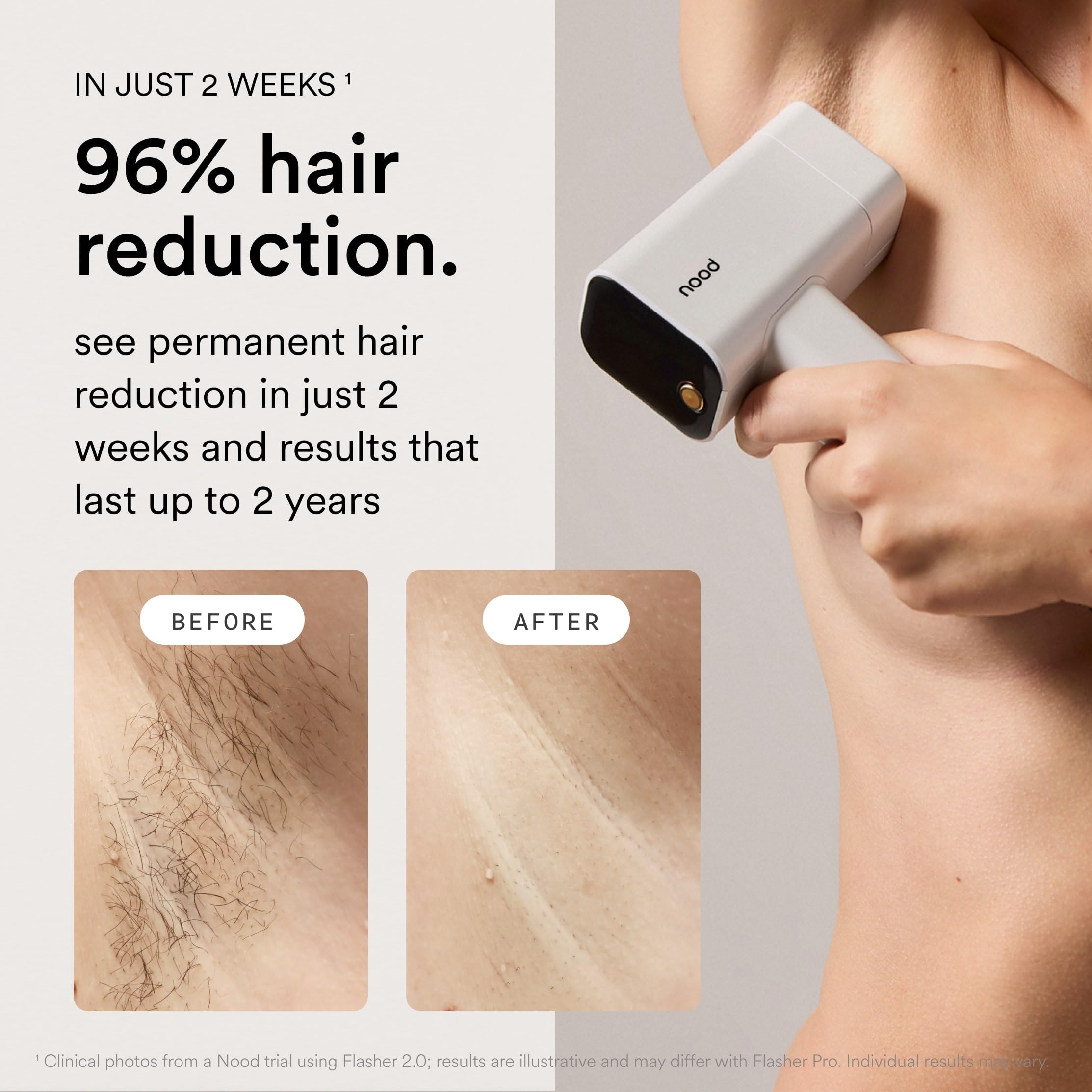 Nood Flasher Pro anti-aging lens attachment for facial rejuvenation sessions
