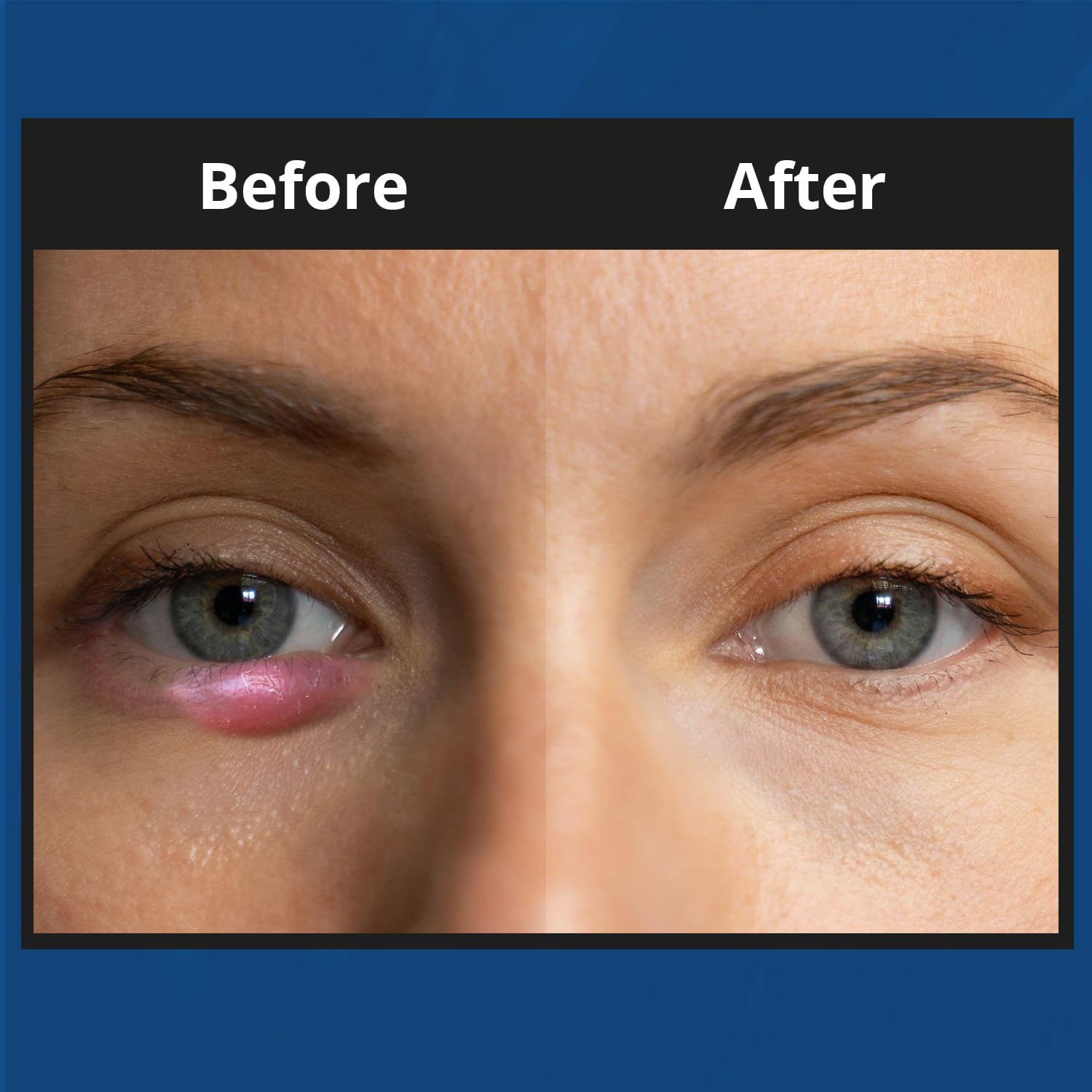 NOVEHA XStye application on the eyelid area for gentle cleansing