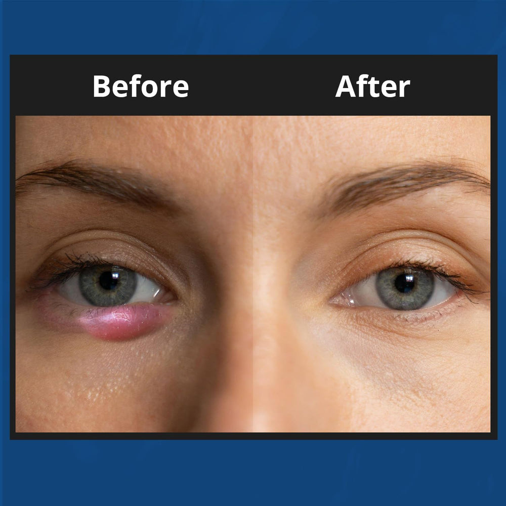 NOVEHA XStye application on the eyelid area for gentle cleansing