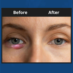 NOVEHA XStye application on the eyelid area for gentle cleansing