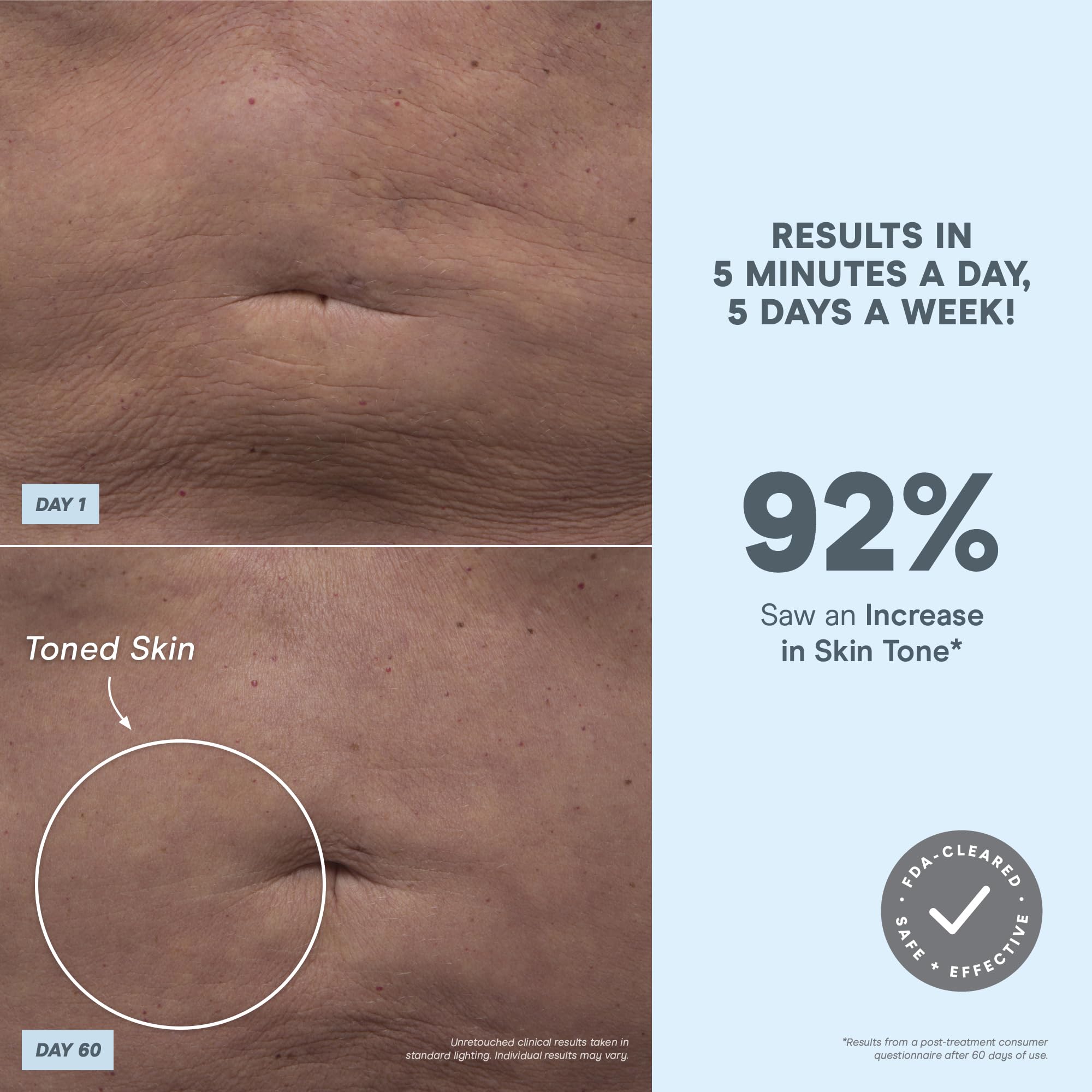 Booty area being lifted with NuBODY for contouring.