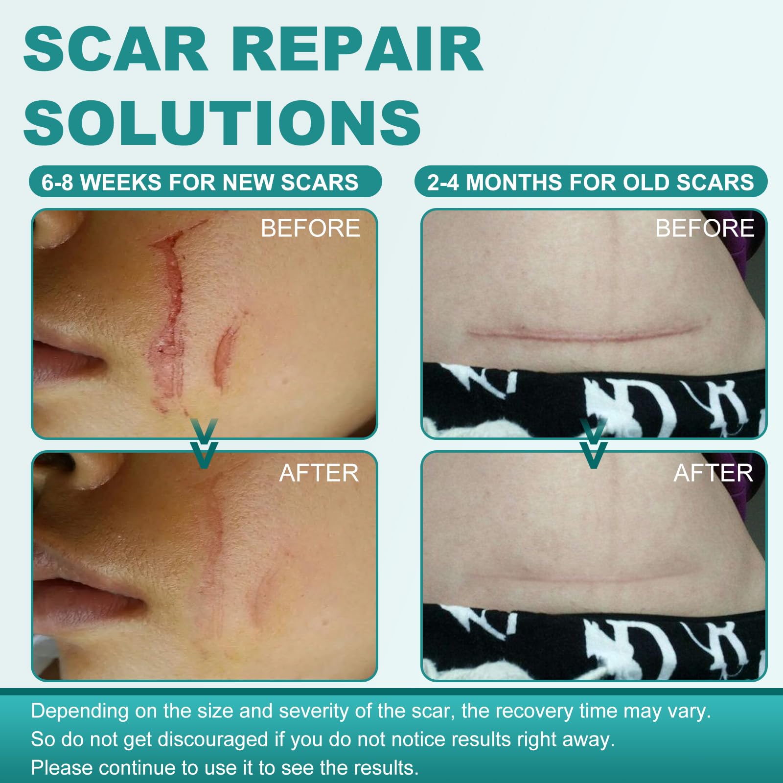 Nullam silicone scar patch cut-to-fit for personalized scar care.