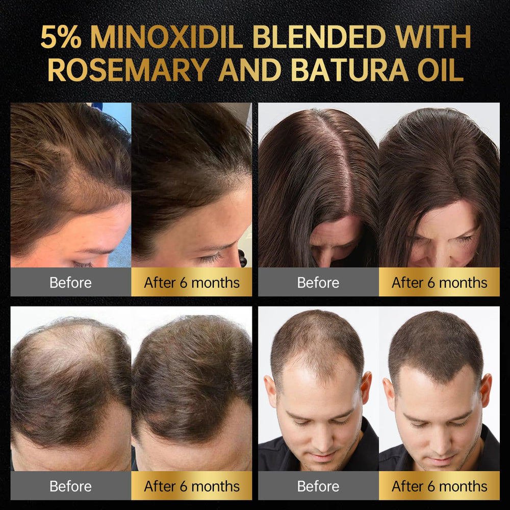 OCSINL Minoxidil massage tip helps reach scalp roots effectively.