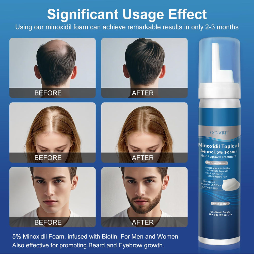 OCVWJKD 5% Minoxidil Foam scalp application demonstrates targeted treatment.