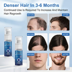 OCVWJKD 5% Minoxidil supports beard growth potential with topical use.