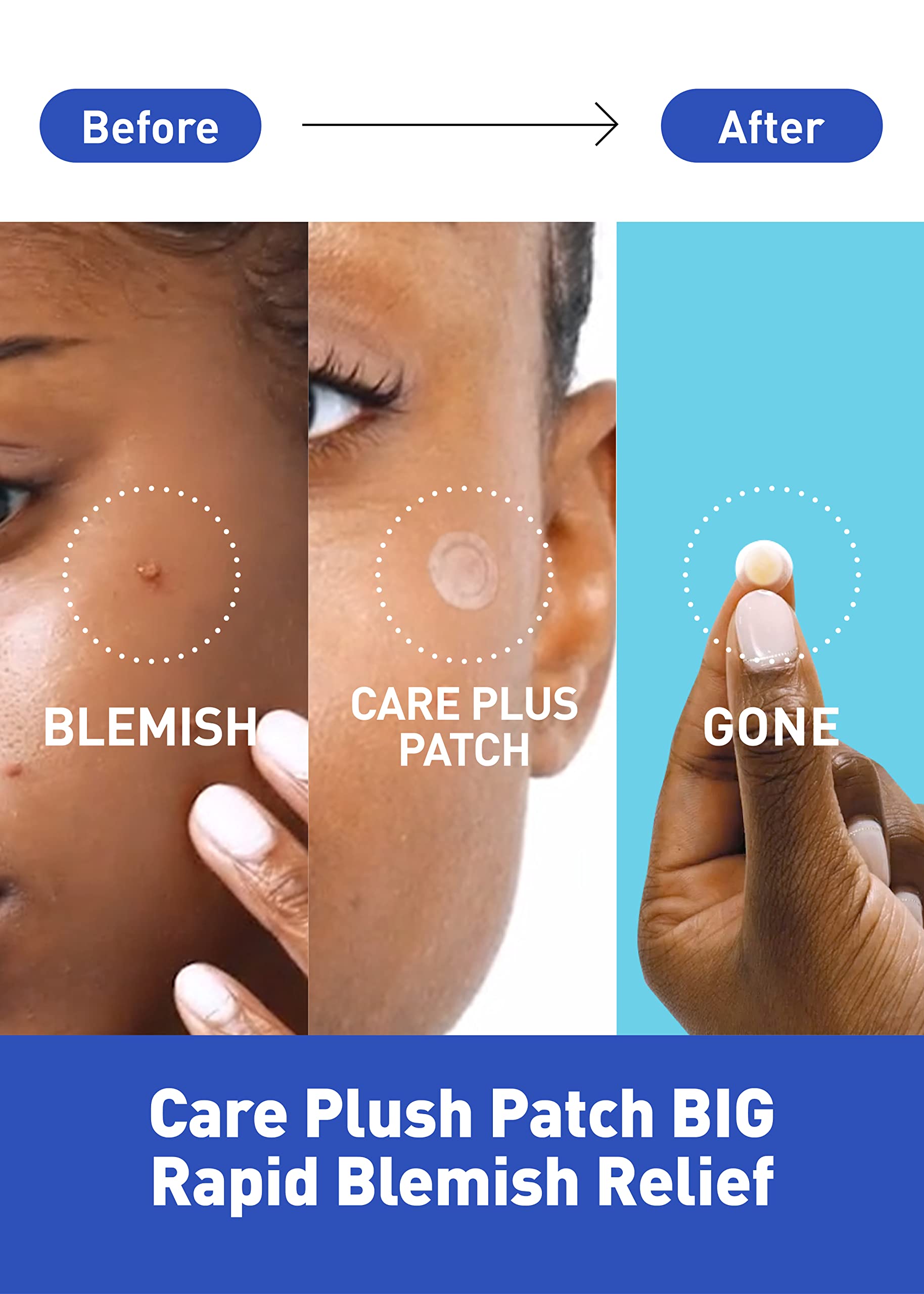 OLIVE YOUNG Care Plus Spot Patch is lightweight and transparent for easy wear.