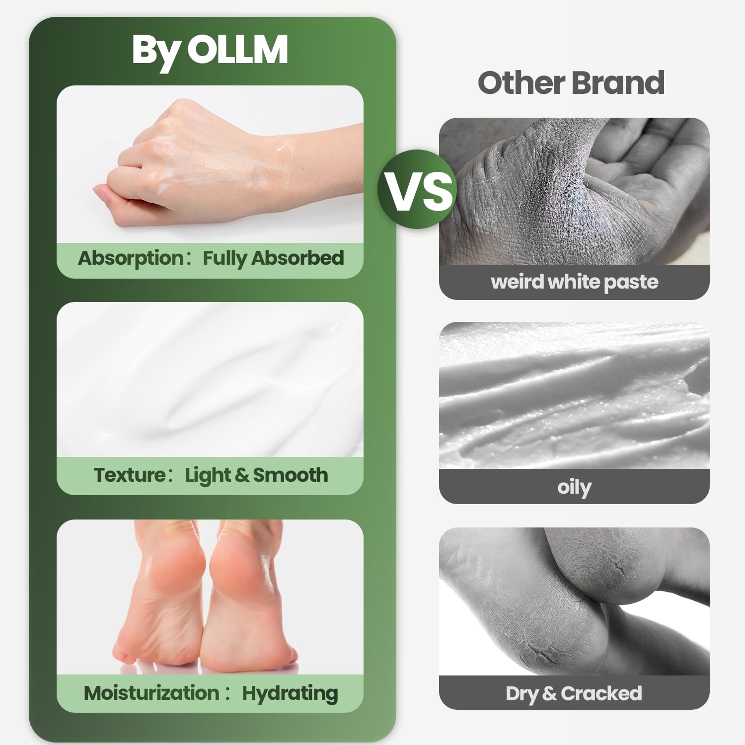 OLL M Urea Cream 40% exfoliates calluses to soften rough areas.
