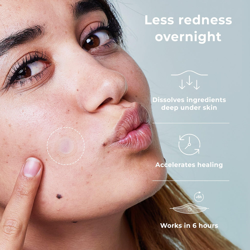 OMMA acne patch on face demonstrates discreet overnight treatment.