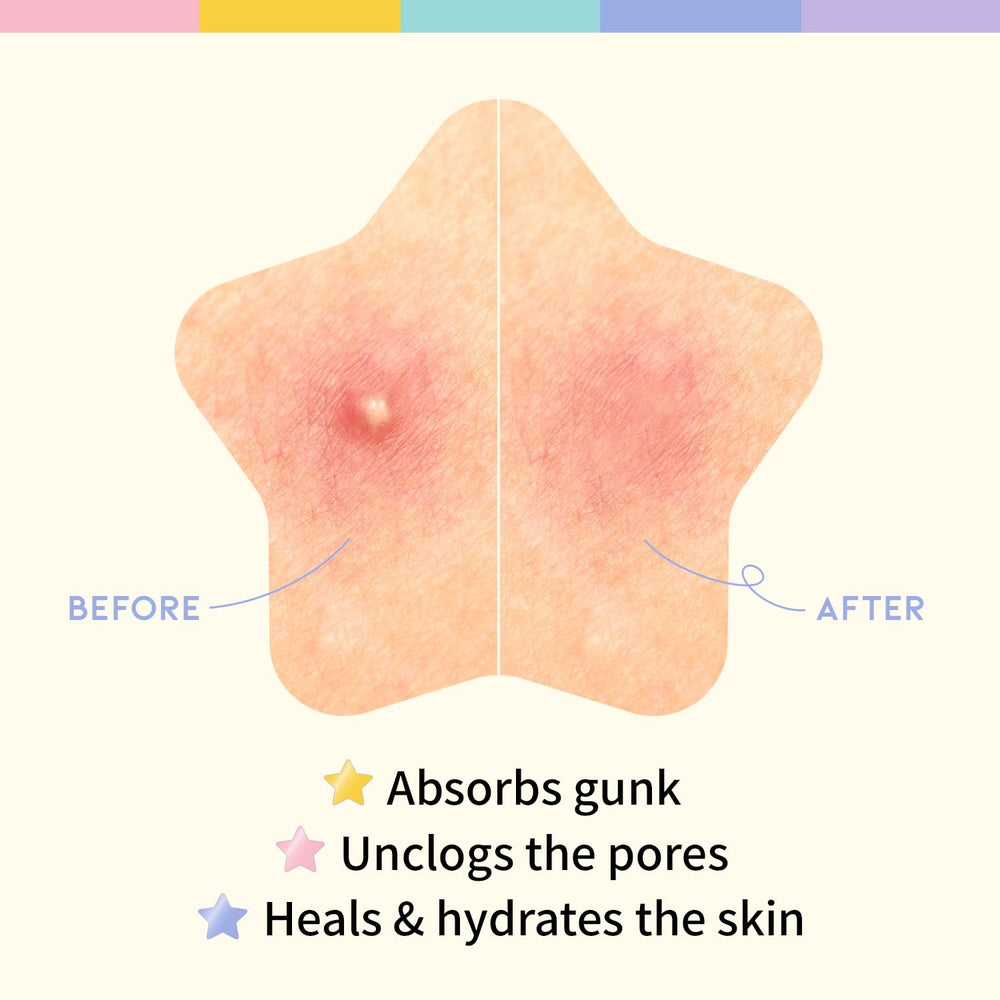 The #OOTD star patches can be worn overnight to protect a blemish.