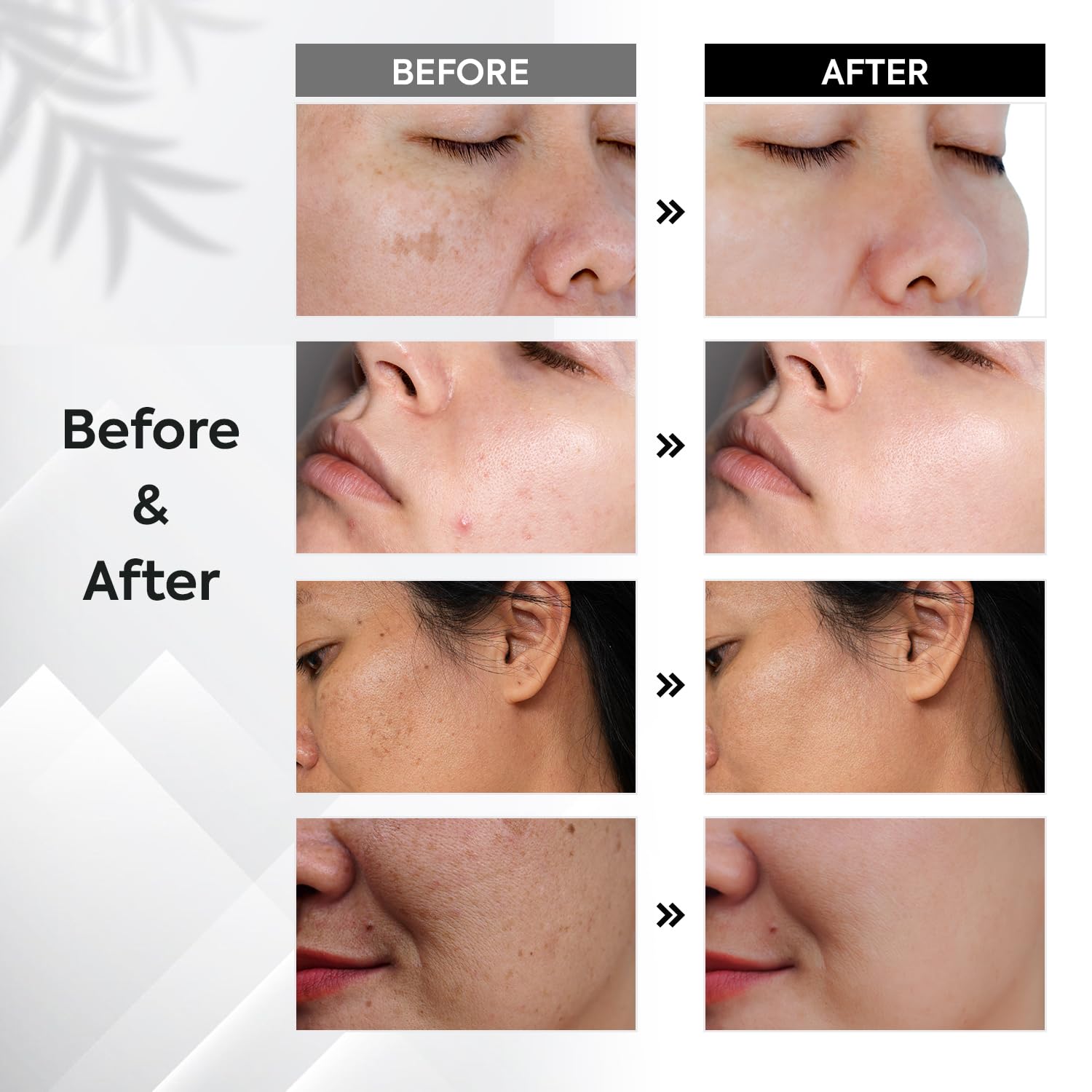 Oudetas Dark Spot Remover hands roller helps even skin tone on the hands.