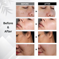 Oudetas Dark Spot Remover hands roller helps even skin tone on the hands.