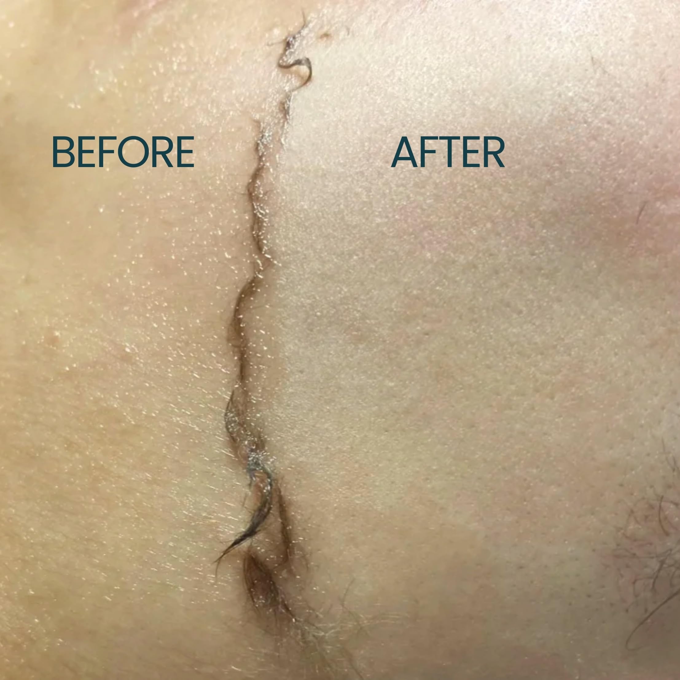 Ouiloe Dermaplane Oil applied on the face for smooth shaving glide.