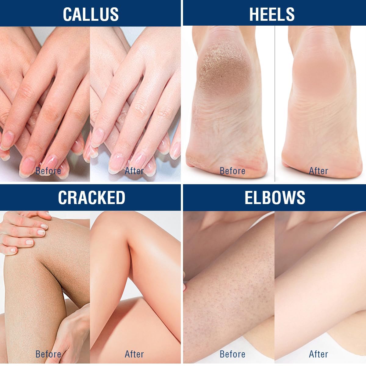 OUKEYA Urea Cream 40% multi-pack emphasizes ongoing foot and hand care