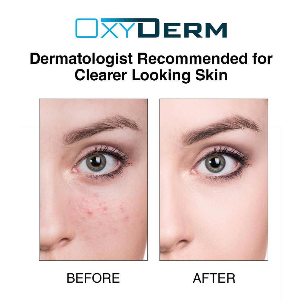 OxyDerm Acne Treatment Pads soft hydrated skin after use visuals.