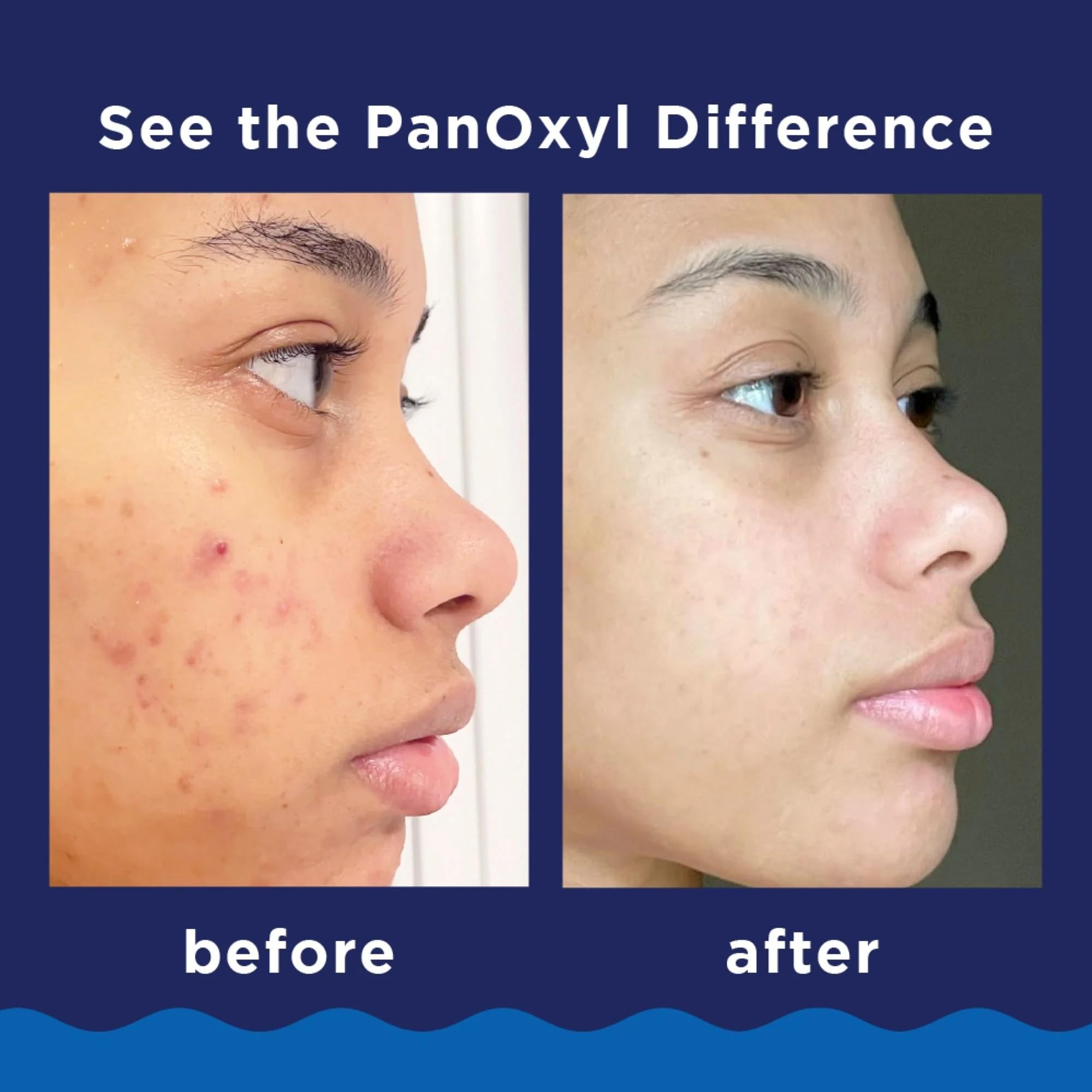 PanOxyl Foaming Acne Wash bottle in a shower setup.
