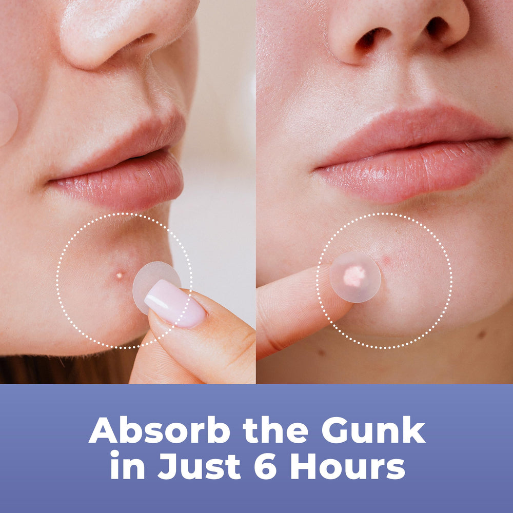 PatchRx Pimple Dots Medium on face for medium blemishes.