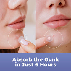 PatchRx Pimple Dots Medium on face for medium blemishes.