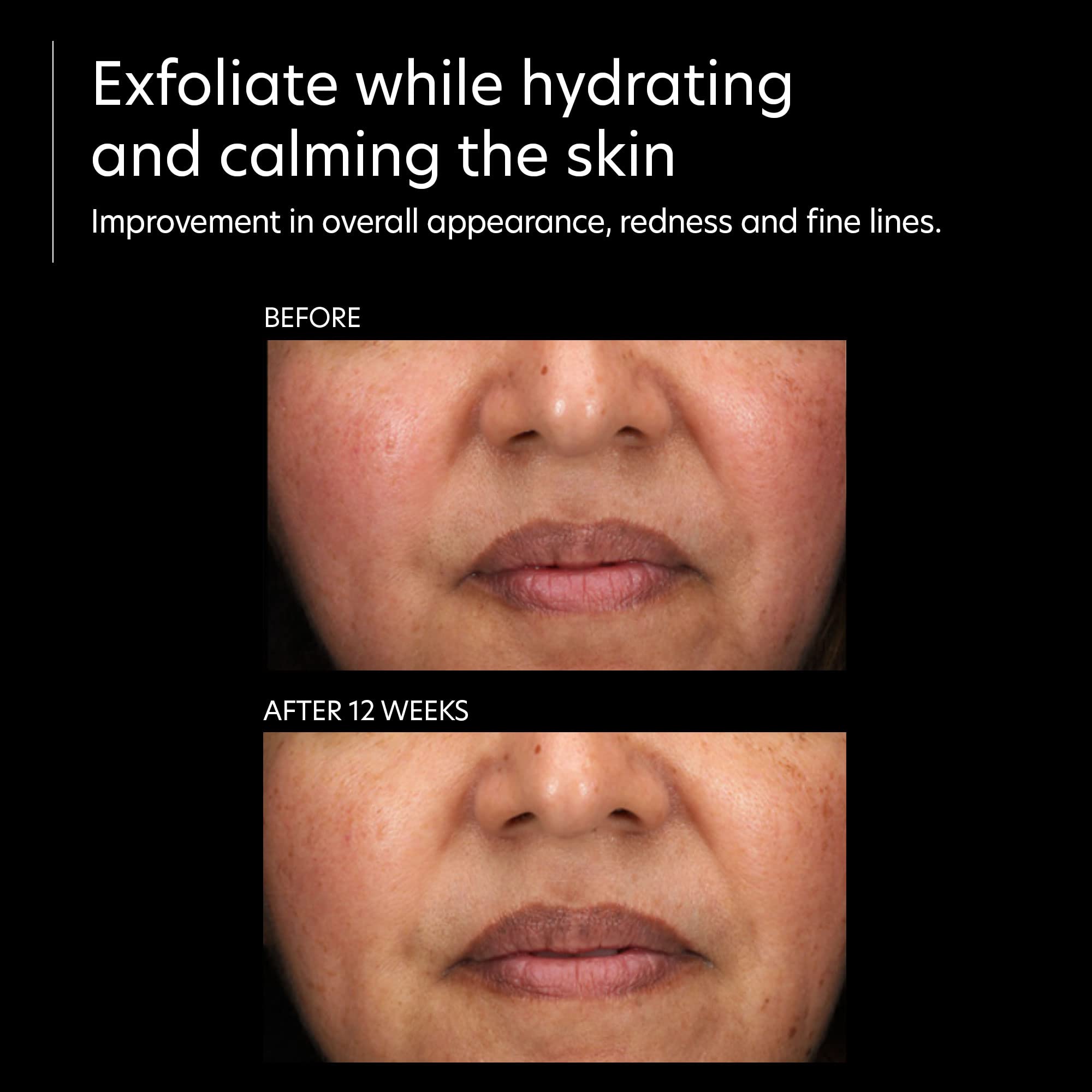 PCA SKIN Resurfacing Serum ingredient close-up shows glycolic-arginine and prickly pear.