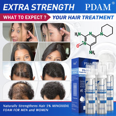 Pdam Minoxidil foam applied to scalp for targeted thinning areas.