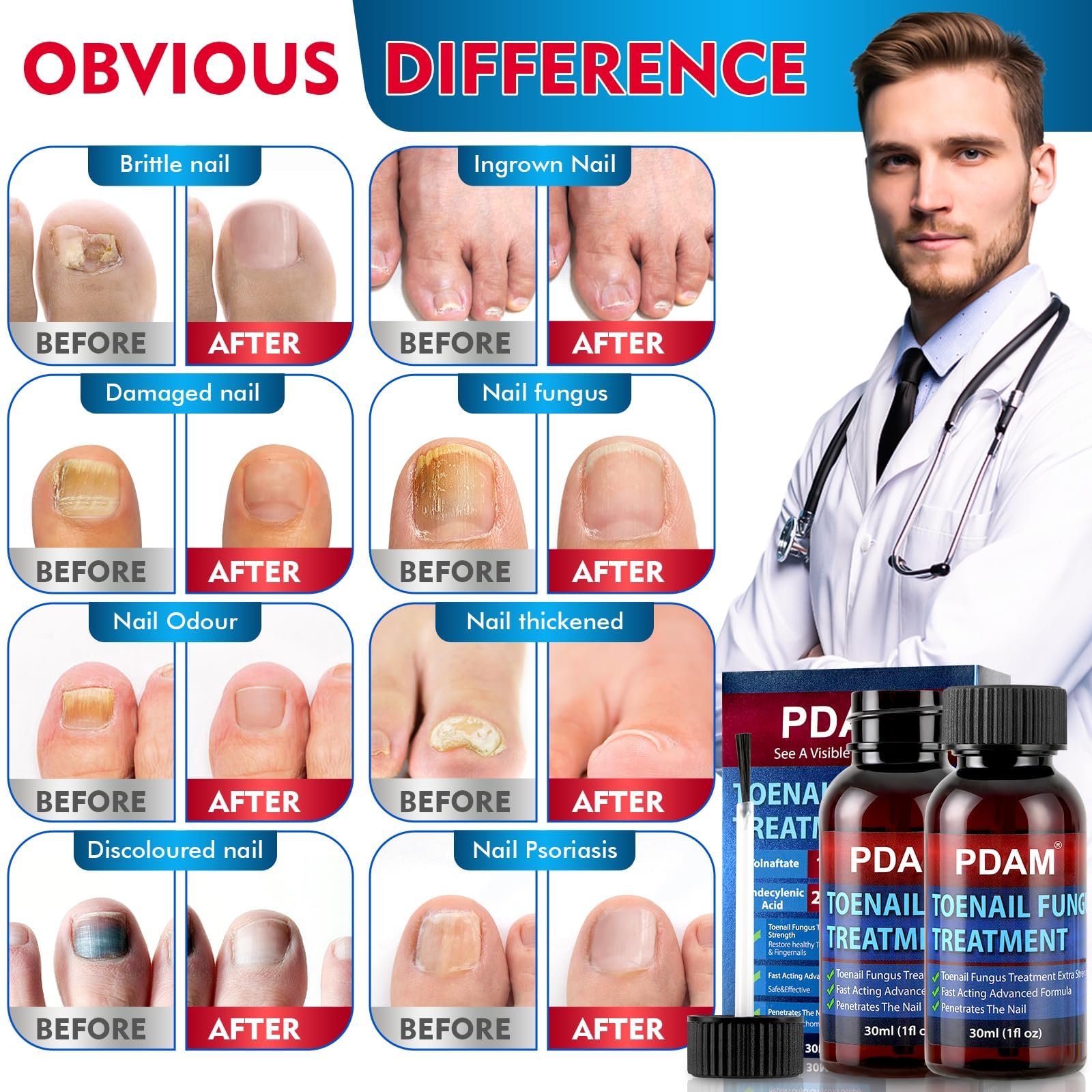 PDAM quick-drying nail fungus liquid on nail.