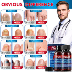 PDAM quick-drying nail fungus liquid on nail.