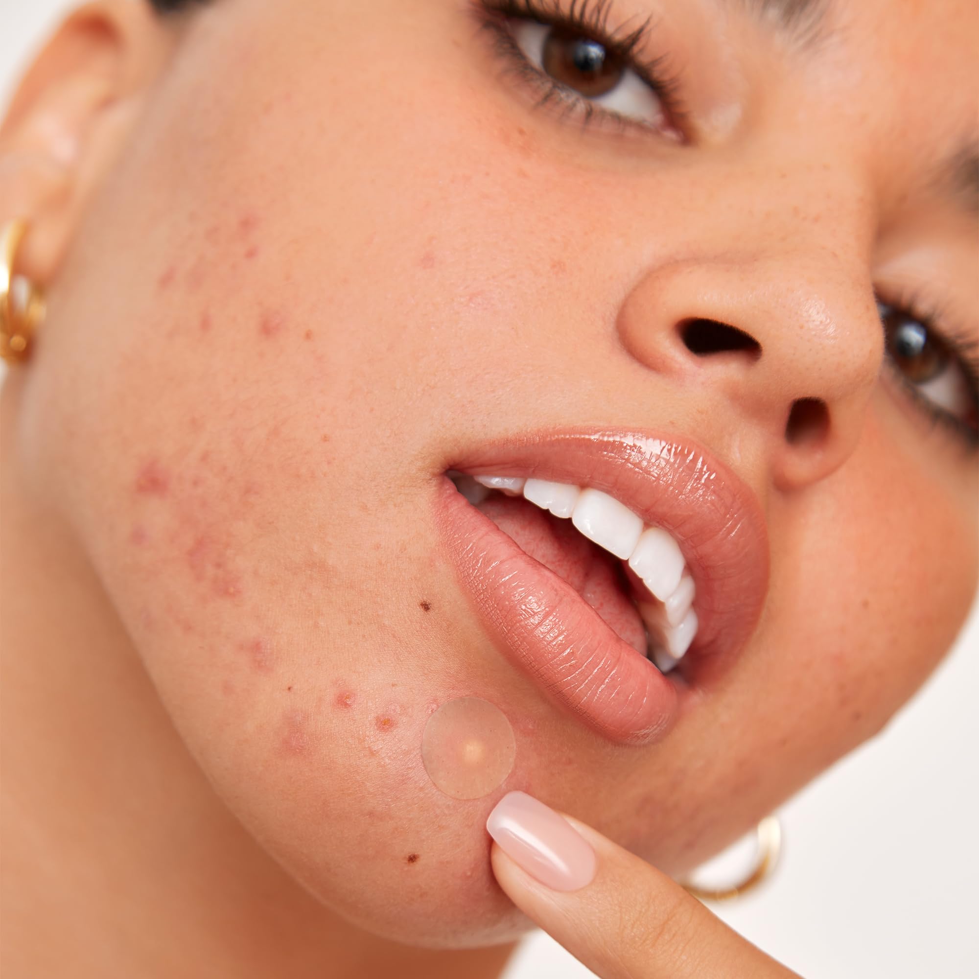 Peace Out Acne Healing Dots adhered to a blemish on the skin.