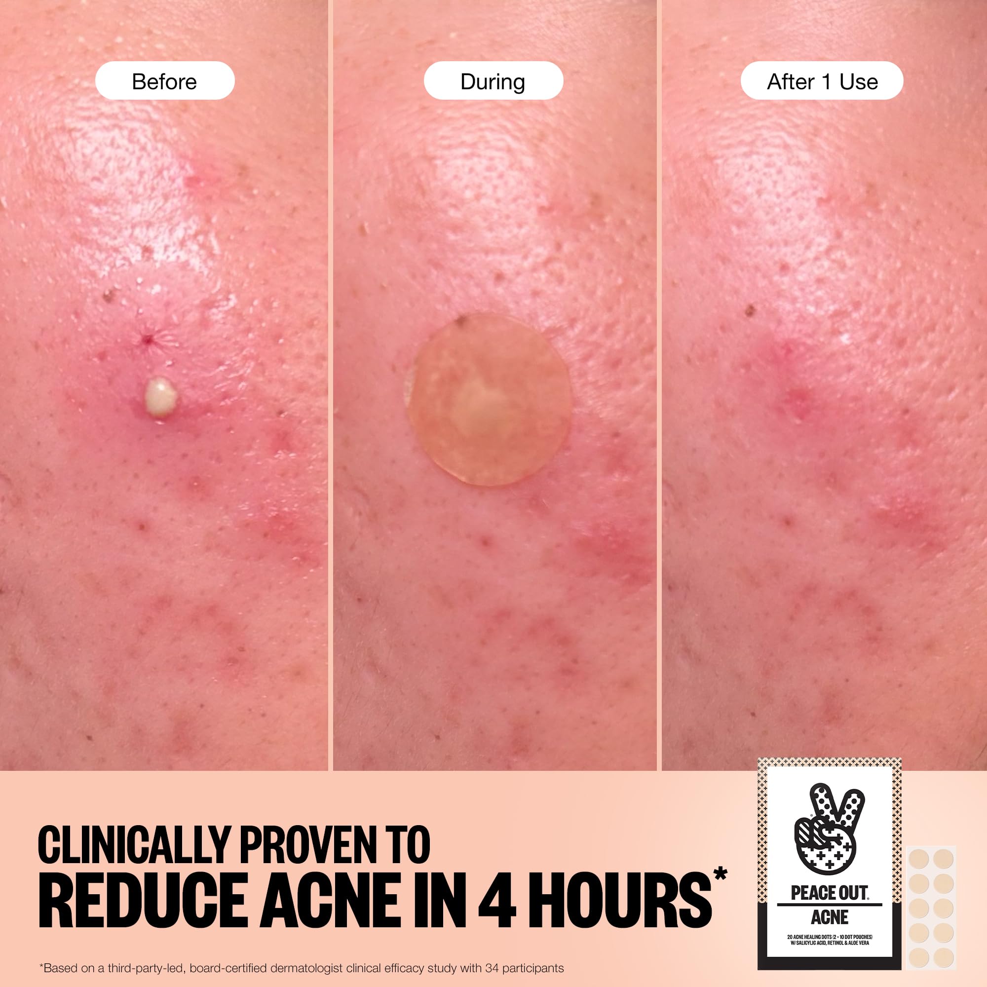 Peace Out Acne Healing Dots close-up of formula with salicylic acid and aloe.