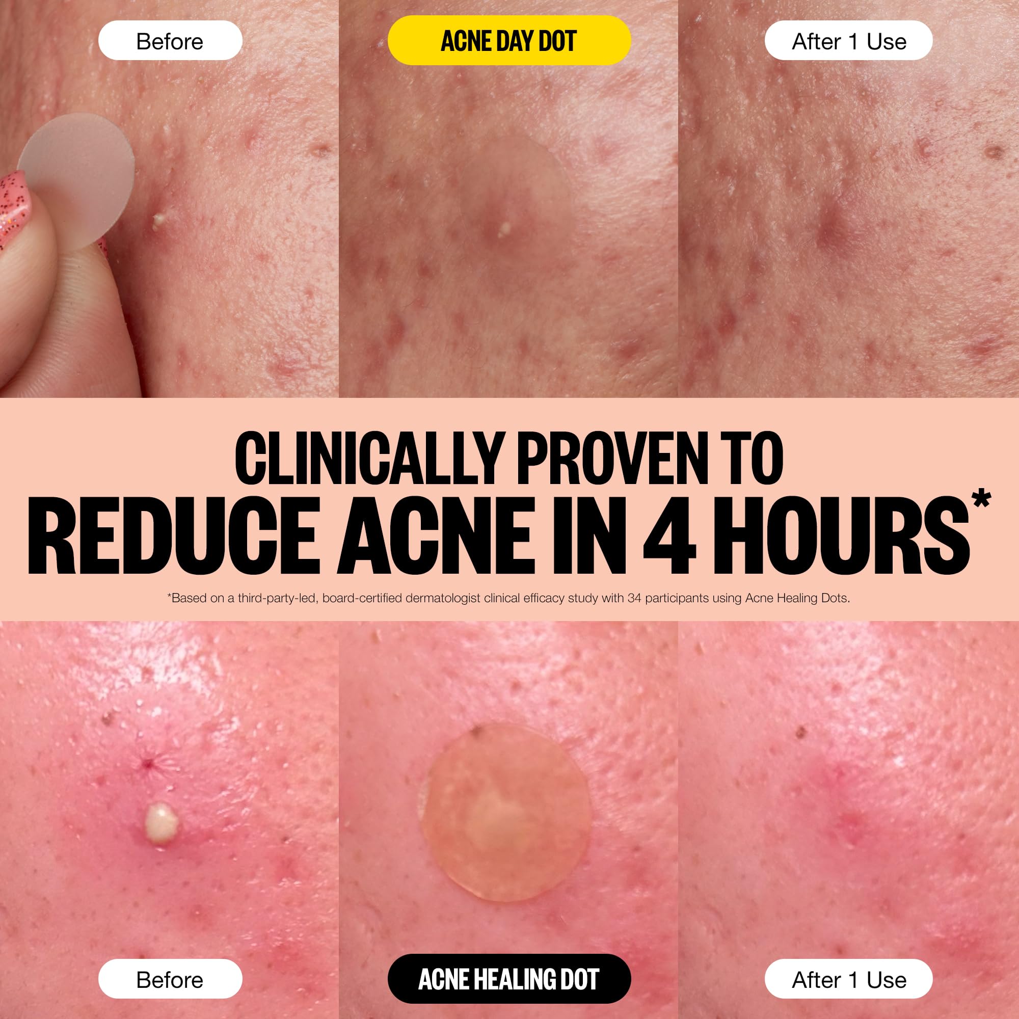 Peace Out Acne Day Dots on skin closeup showing discreet coverage