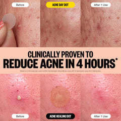 Peace Out Acne Day Dots on skin closeup showing discreet coverage