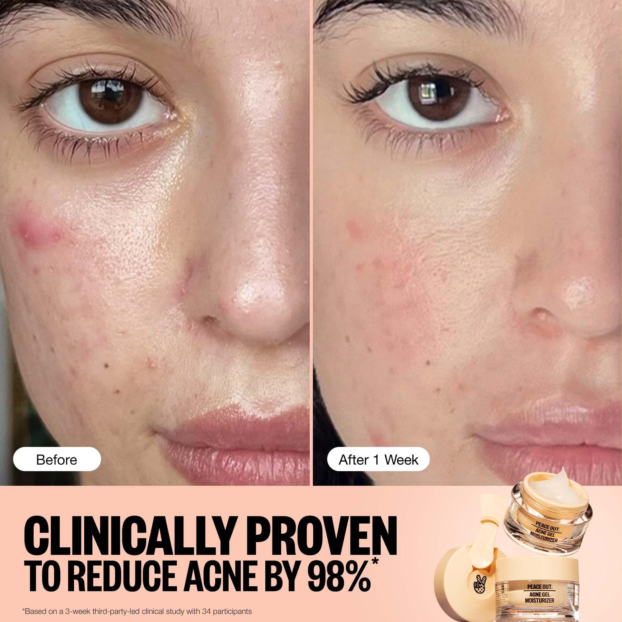 PEACE OUT Acne Gel Moisturizer on the face demonstrates lightweight hydration without clogging pores.