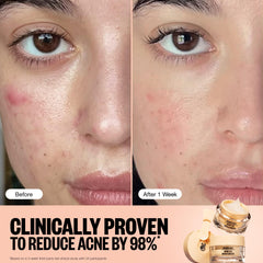 PEACE OUT Acne Gel Moisturizer on the face demonstrates lightweight hydration without clogging pores.