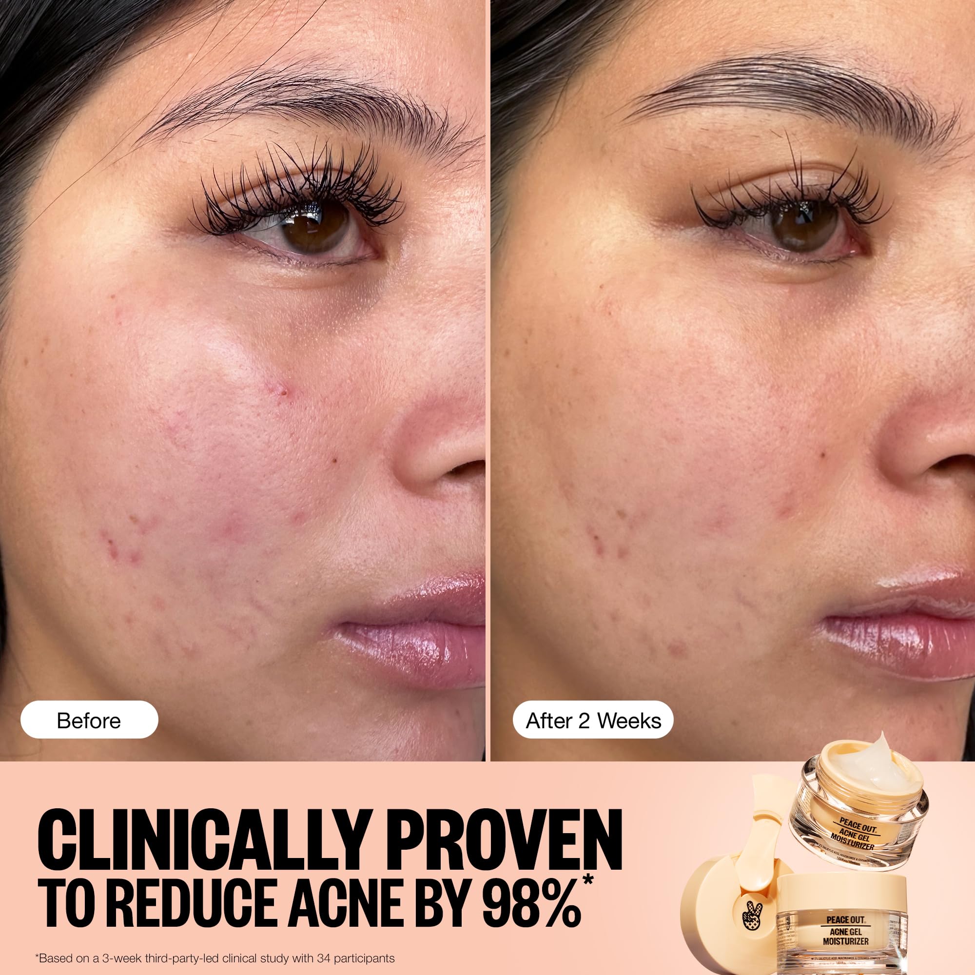 PEACE OUT Acne Gel Moisturizer ingredients niacinamide and salicylic acid support blemish care.