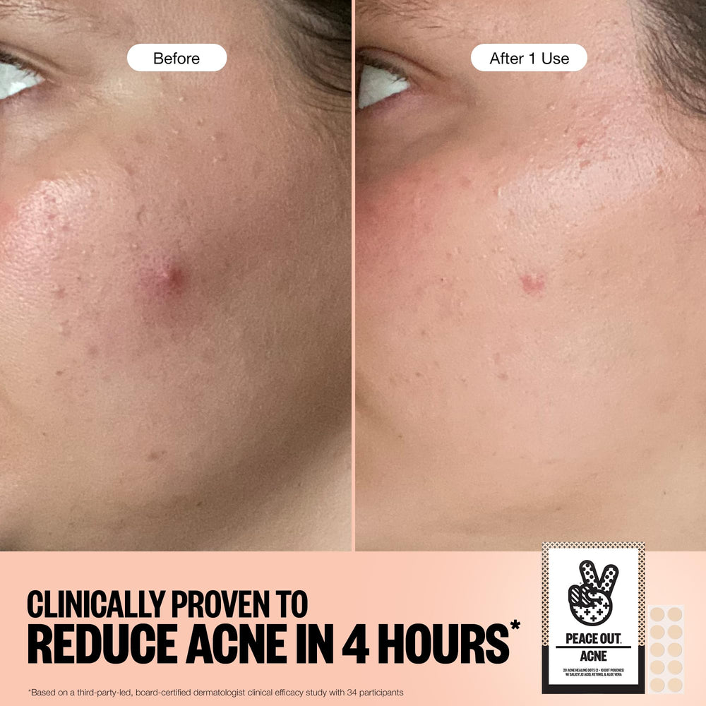 Peace Out Acne Healing Dots ready for daytime or overnight use, discreet under makeup.
