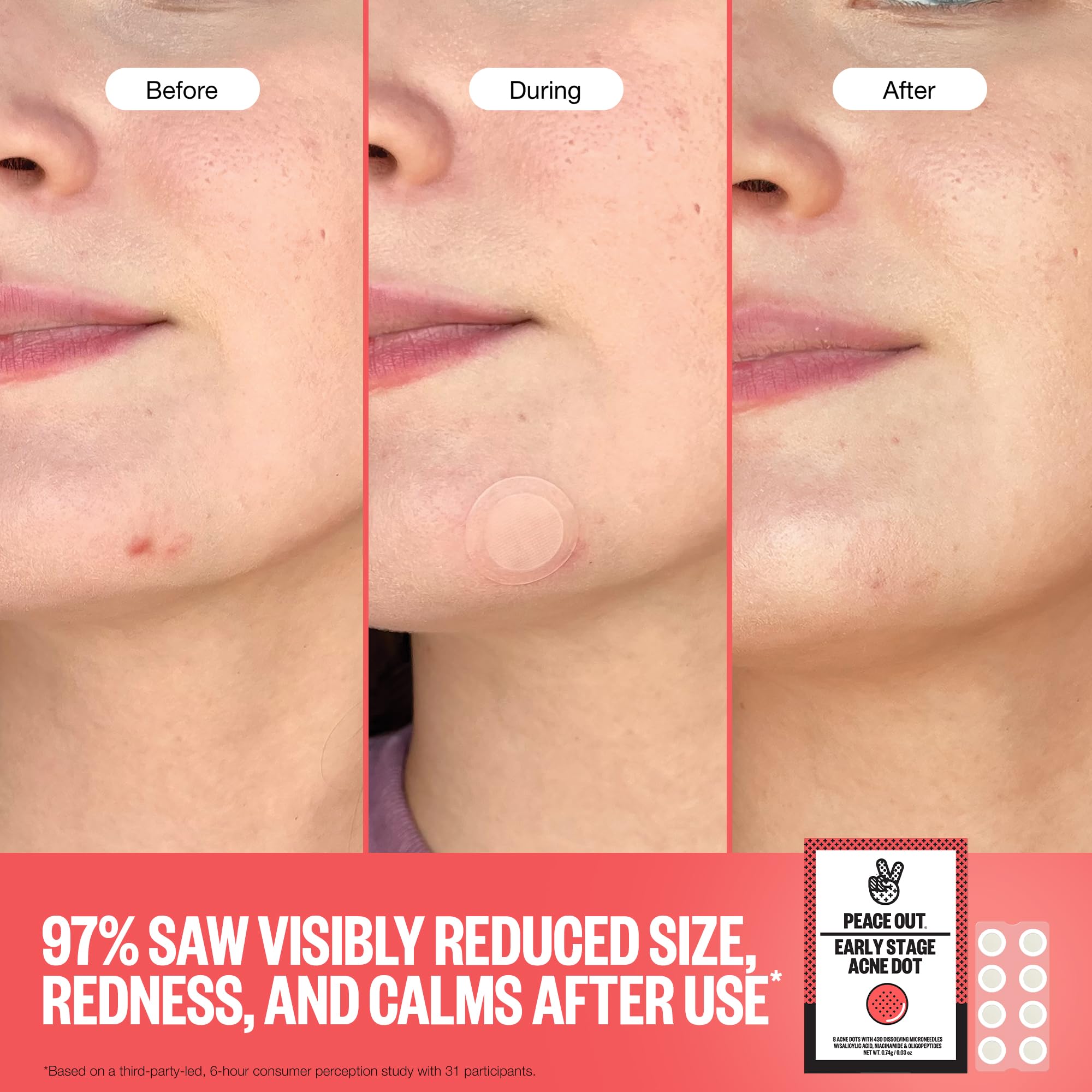 PEACE OUT Early Stage Acne Dots worn on the face in daily routine