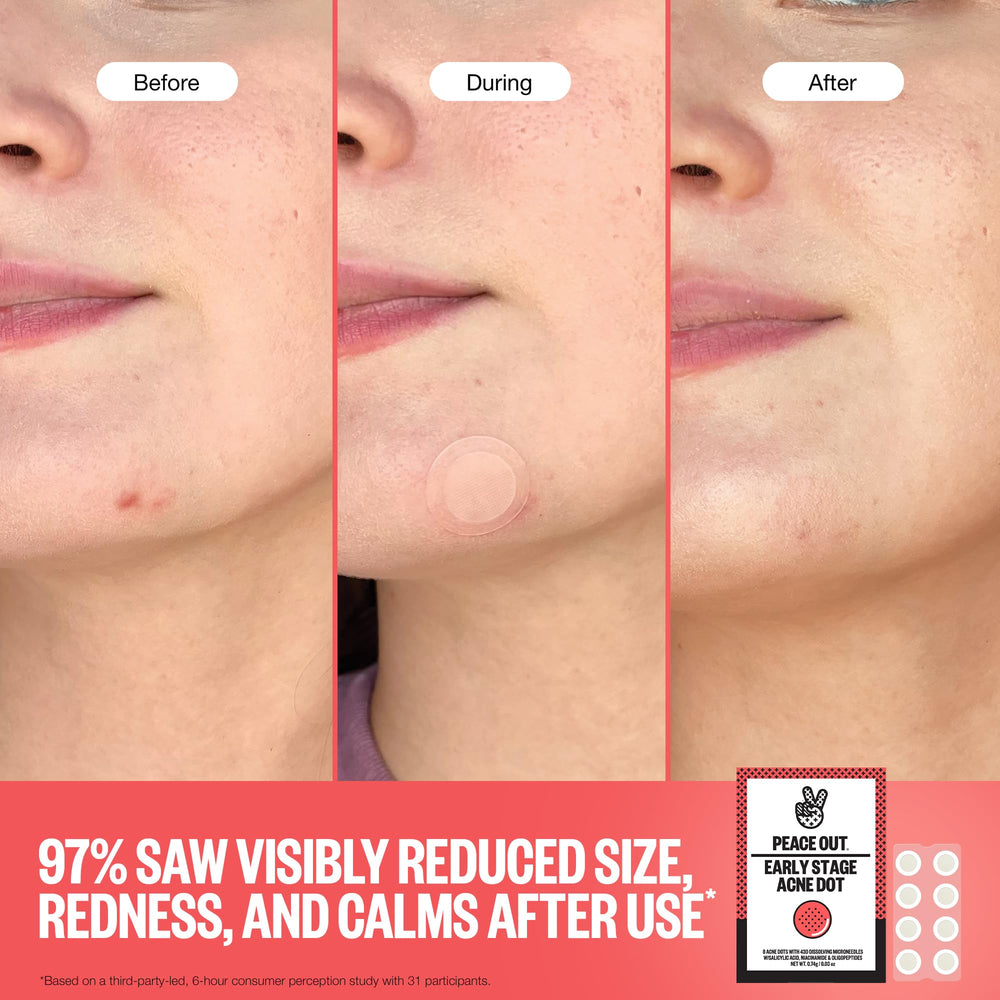 PEACE OUT Early Stage Acne Dots worn on the face in daily routine