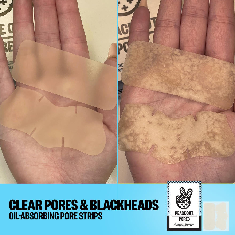 Peace Out hydrocolloid-strip close-up in action draws impurities from pores.