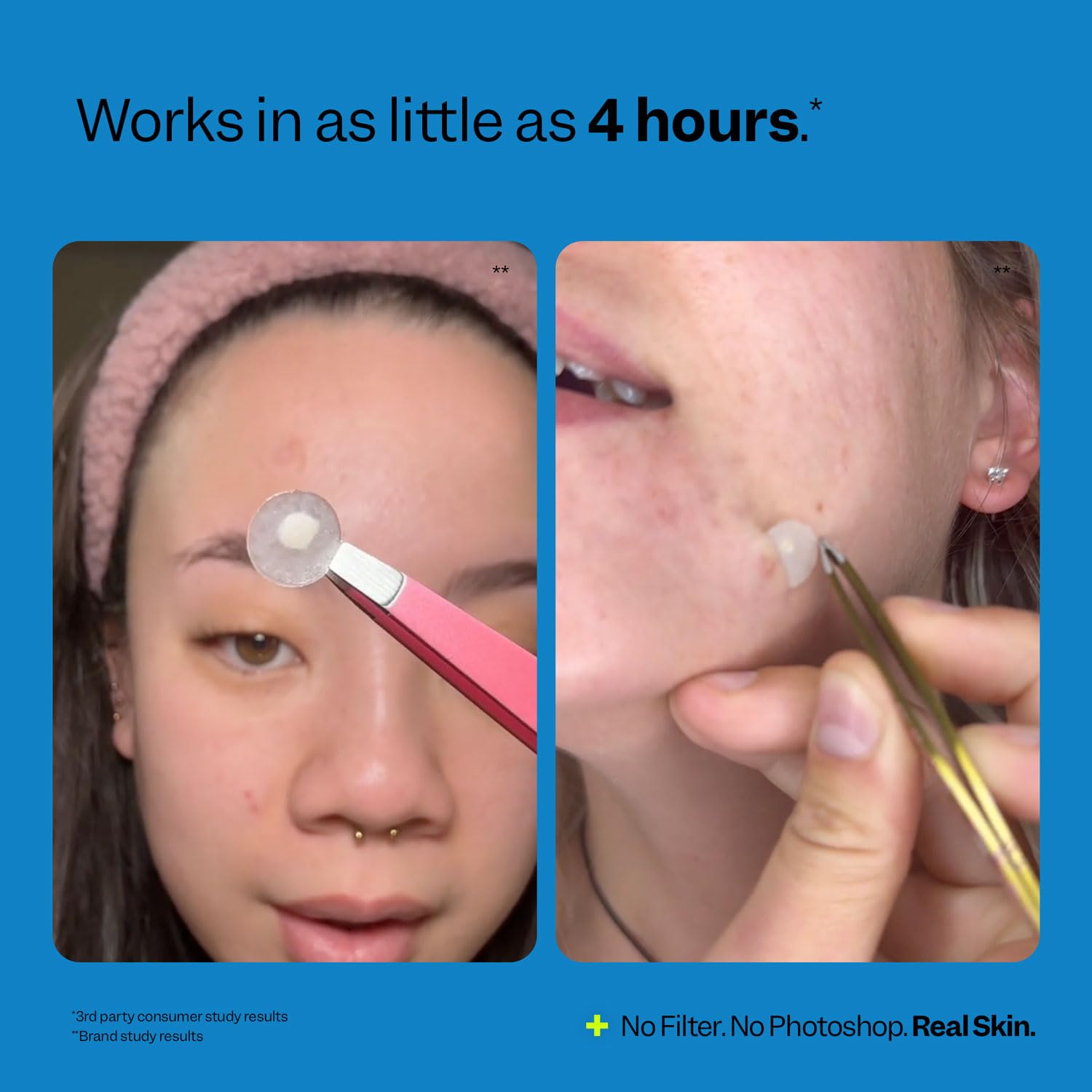 Peach Slices hydrocolloid patch absorbing gunk from blemish.