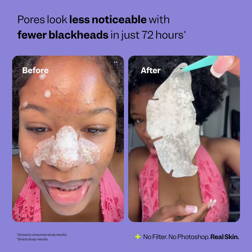 Peach Slices patch applied on nose reinforces gentle adhesion for overnight use.