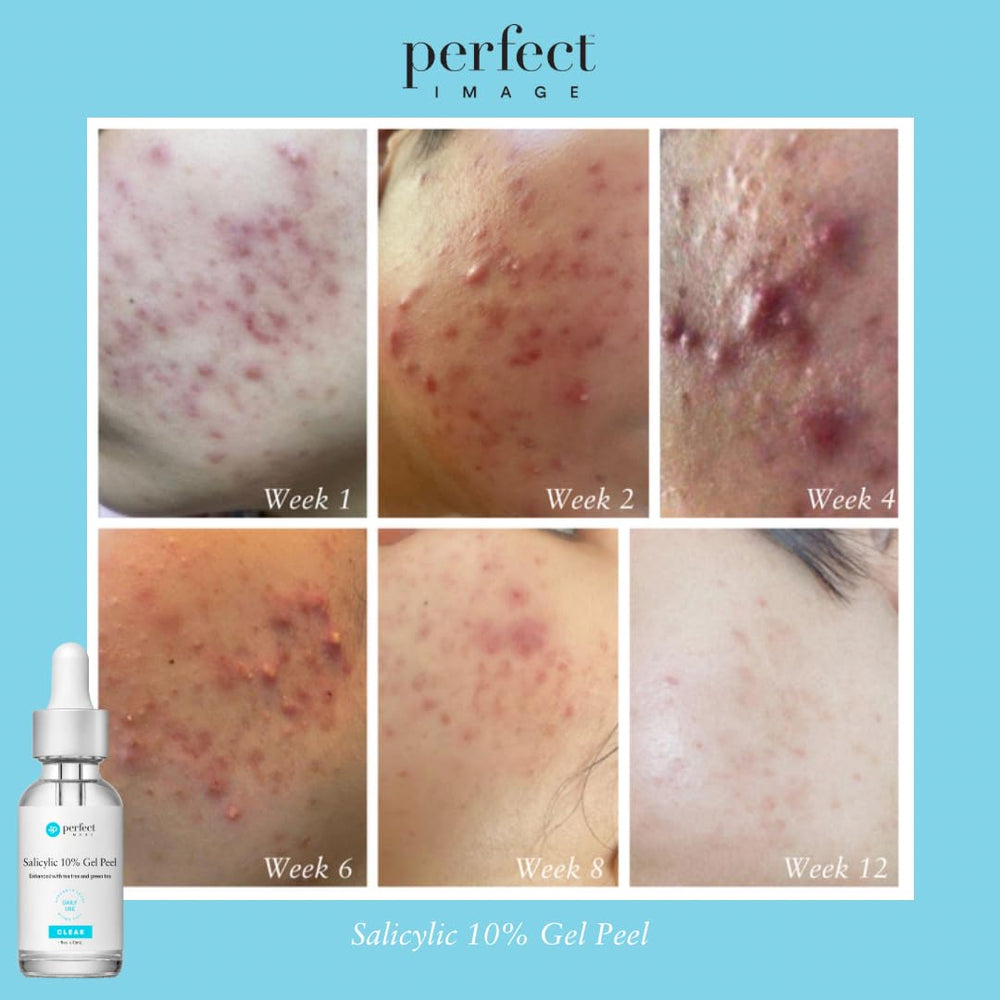 Perfect Image gel peel imagery with cucumber and chamomile soothing extracts.