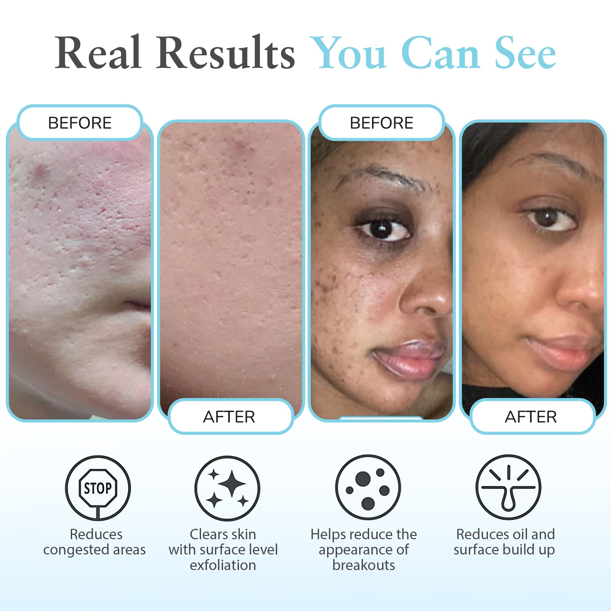 Perfect Image gel peel shows oil control for clearer, less shiny skin.