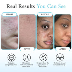 Perfect Image gel peel shows oil control for clearer, less shiny skin.
