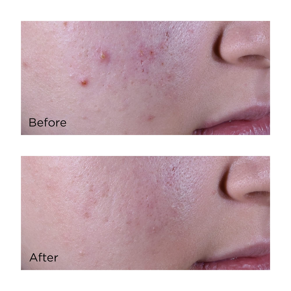 Perricone MD Acne Relief Clearing packaging shot suitable for daily skincare routine