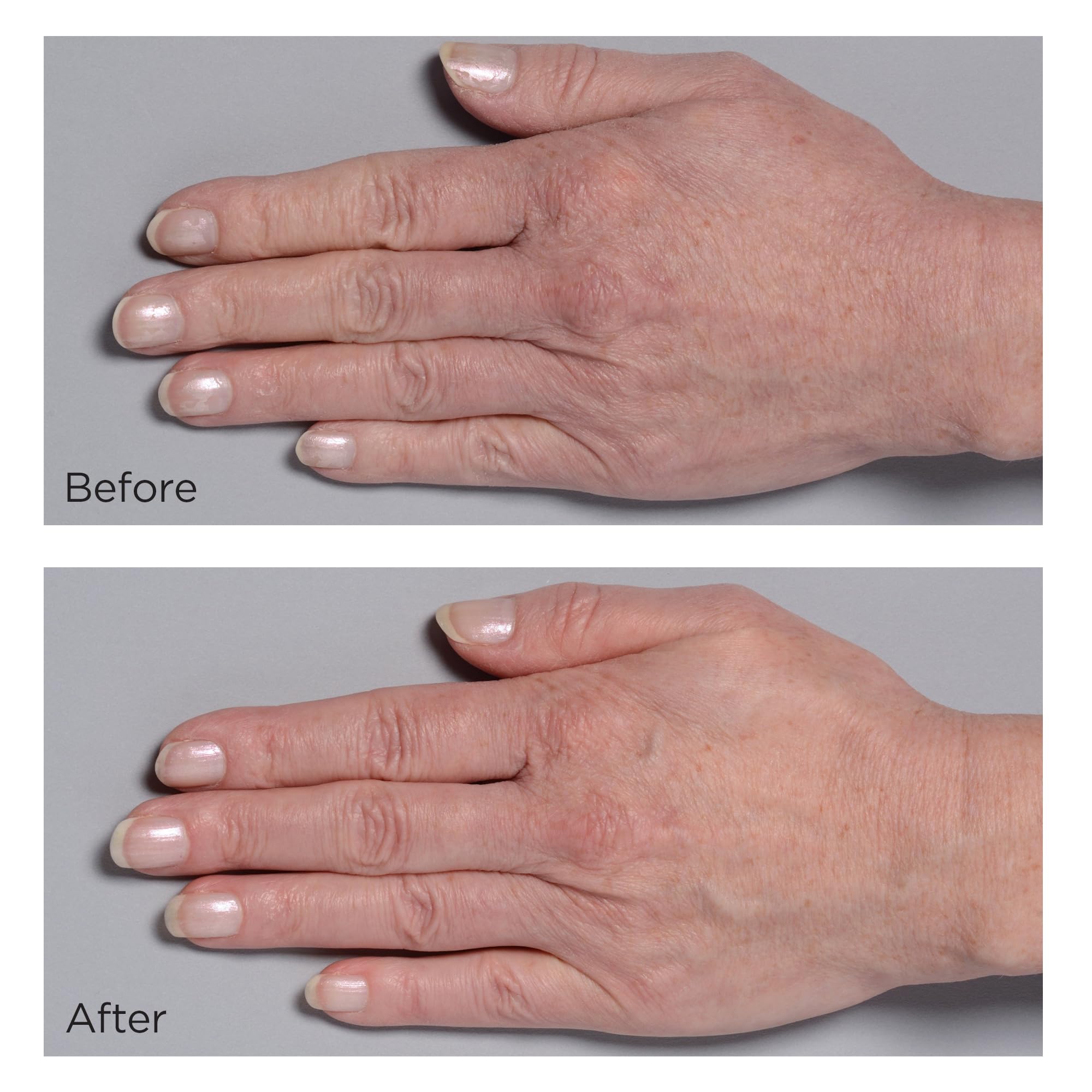 Perricone MD Cold Plasma Hand Therapy on hands, visible reduction of crepey appearance.