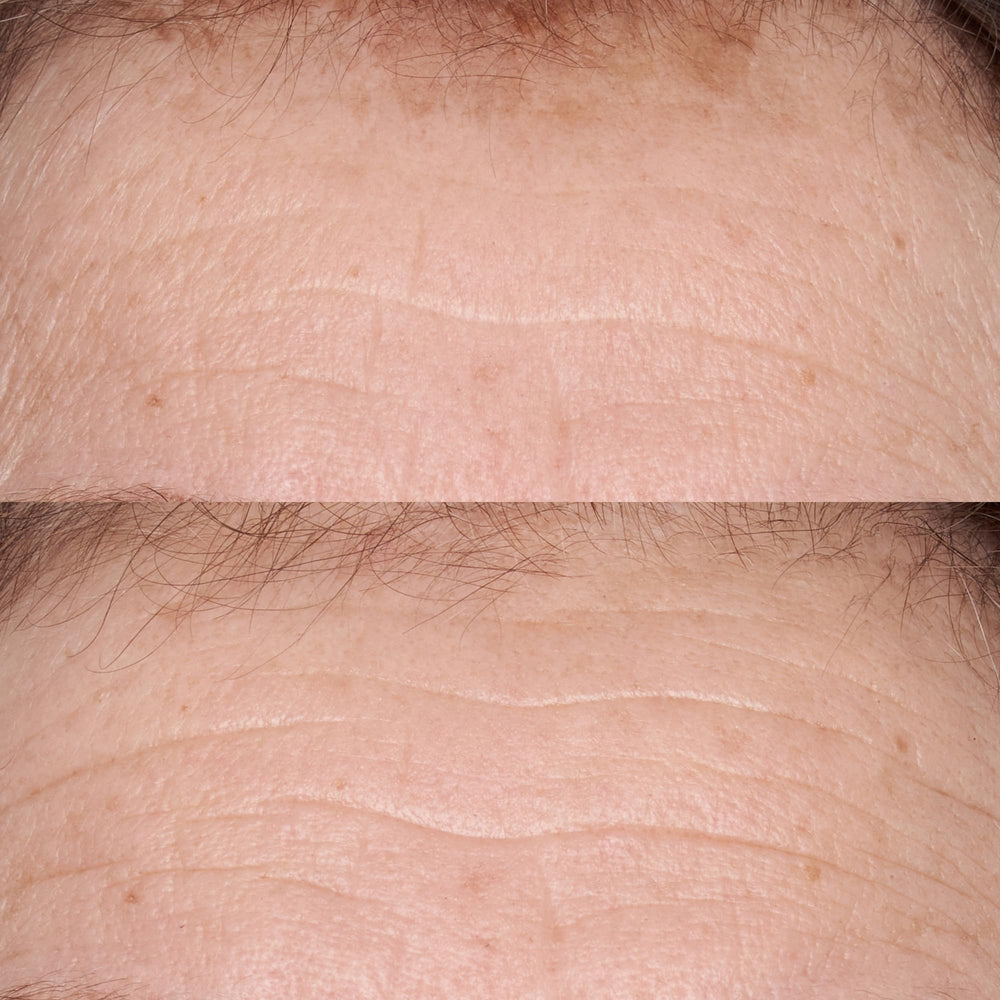 Perricone MD hypoallergenic serum applied during routine for smoother skin