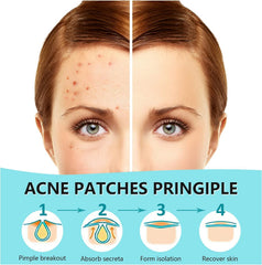 PICcircuit pimple patch 12mm covers larger spots for safe healing.
