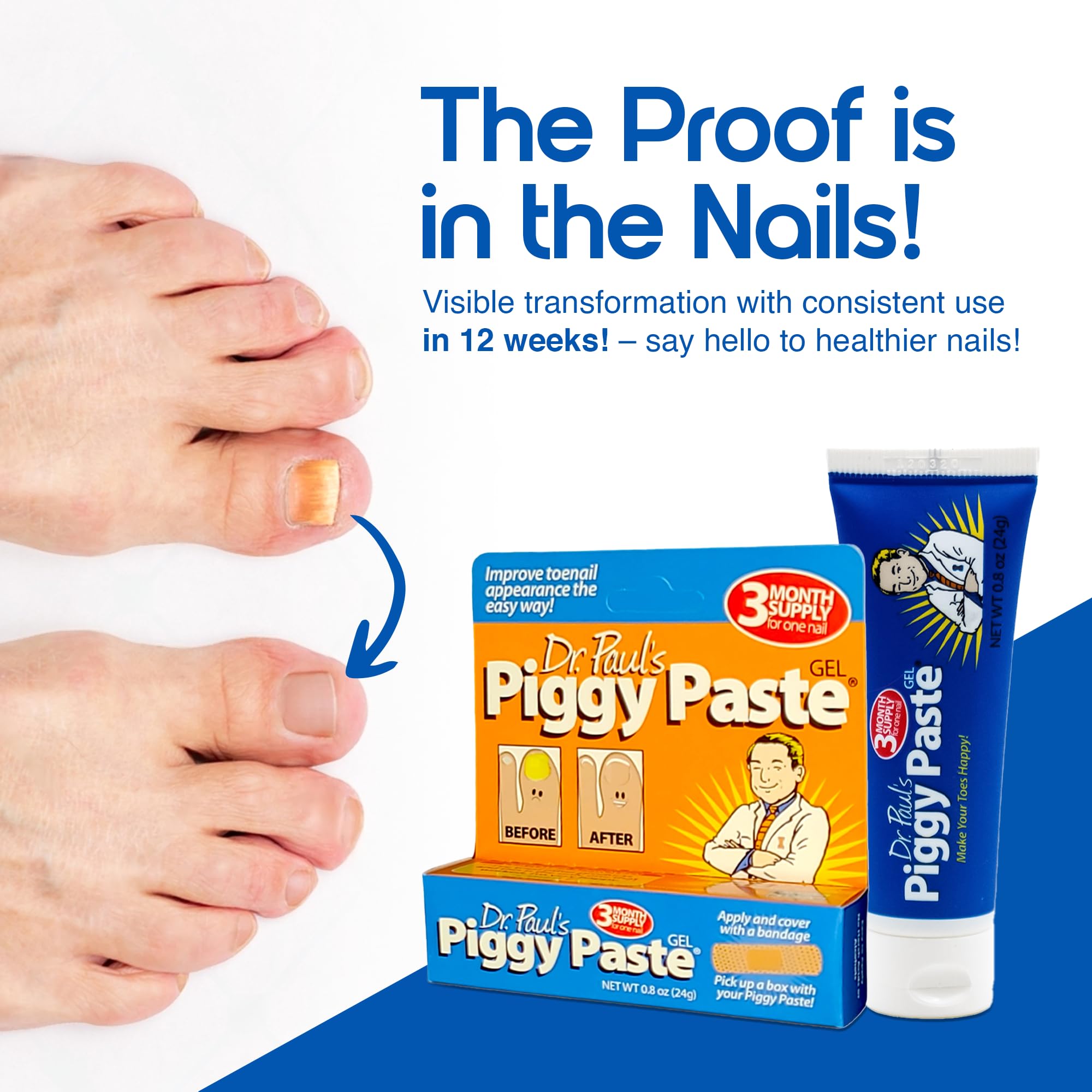 Piggy Paste Gel on yellow brittle nail showing discoloration needing care