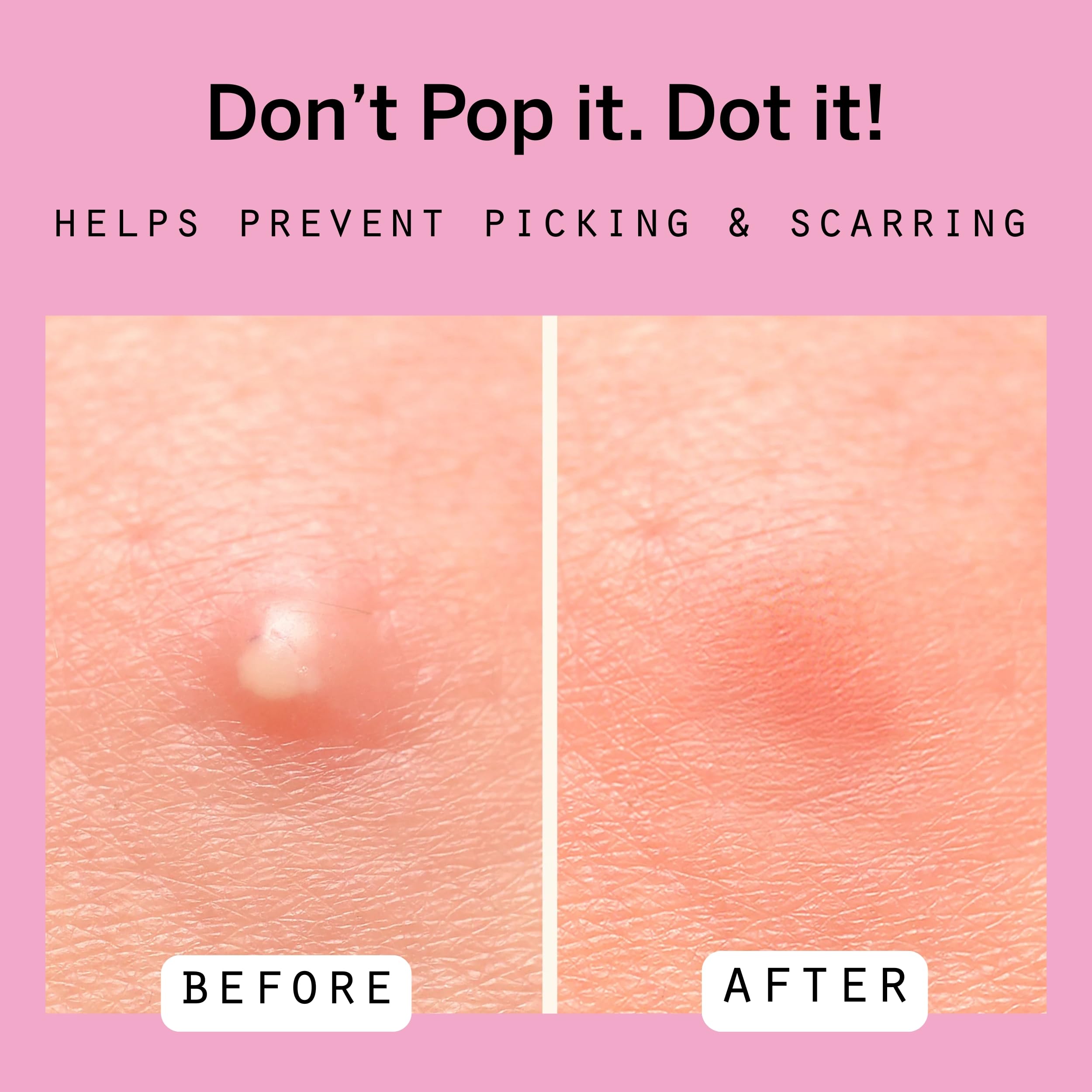 Pixie Cup Dot 8mm patch blends invisibly for day wear