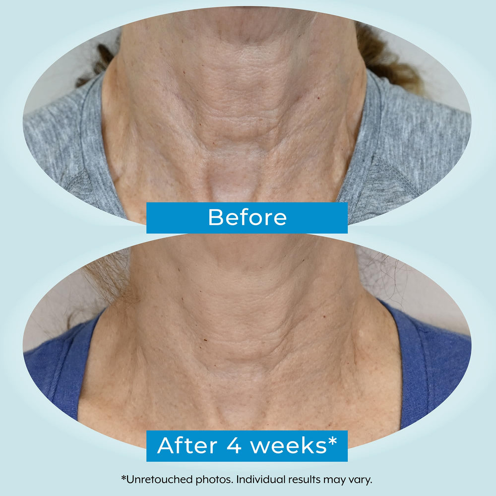 Plexaderm crepey skin neck closeup suggests improved suppleness.